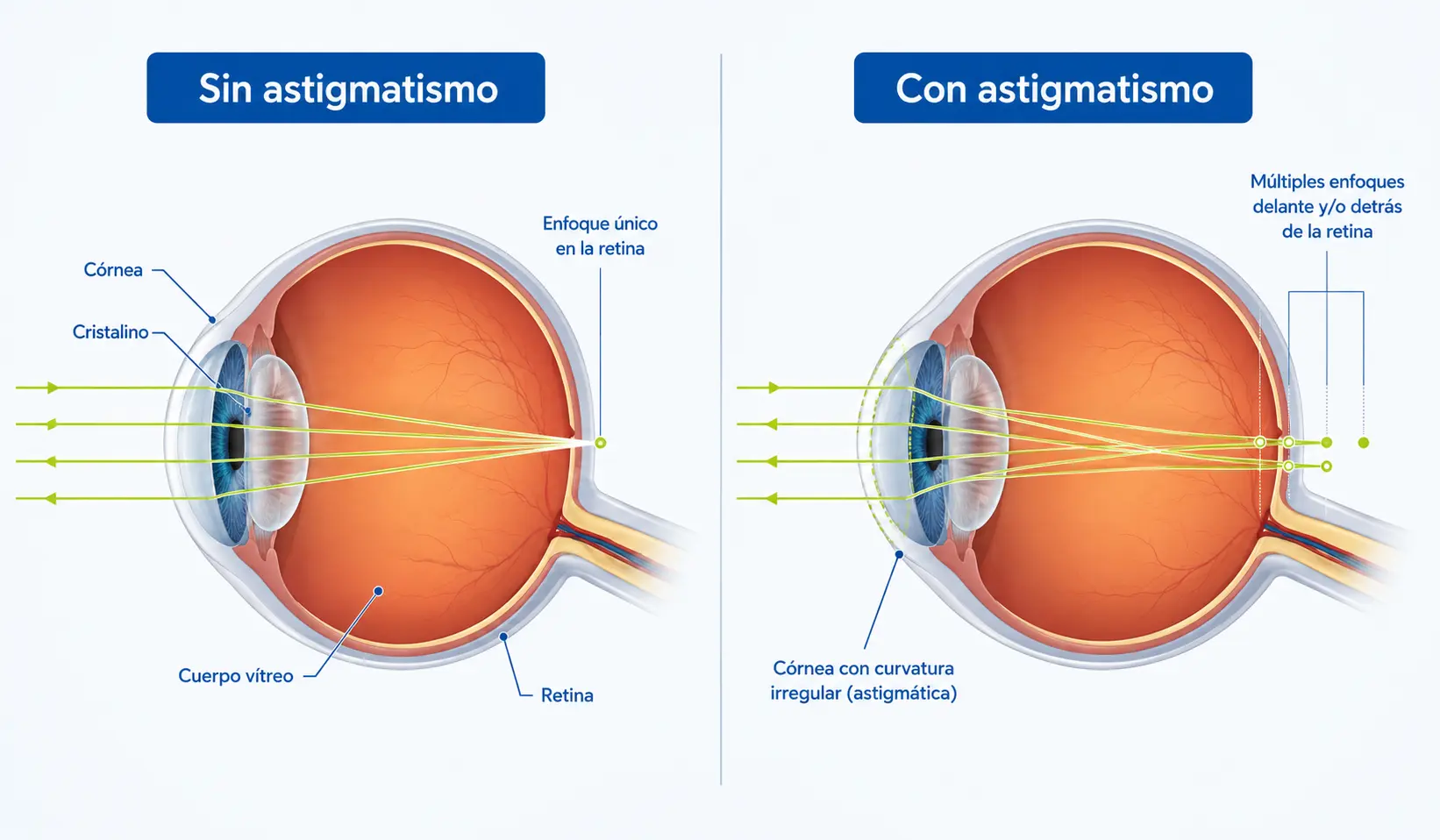 Diagrama comparativo que muestra la diferencia entre un ojo sin astigmatismo y un ojo con astigmatismo explicando el enfoque de la luz sobre la retina.