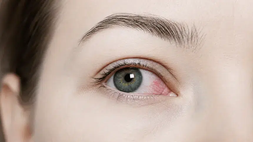 conjuntivitis_ojo_rojo_sintomas_ocumed_queretaro_550x310 Primer plano de un ojo con enrojecimiento en la conjuntiva, característico de los síntomas de la conjuntivitis.