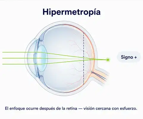hipermetropia_enfoque_despues_retina_ocumed_queretaro_481x400 Infografía sobre Hipermetropía que muestra los rayos de luz enfocándose después de la retina, el signo positivo de la graduación y la visión cercana con esfuerzo.