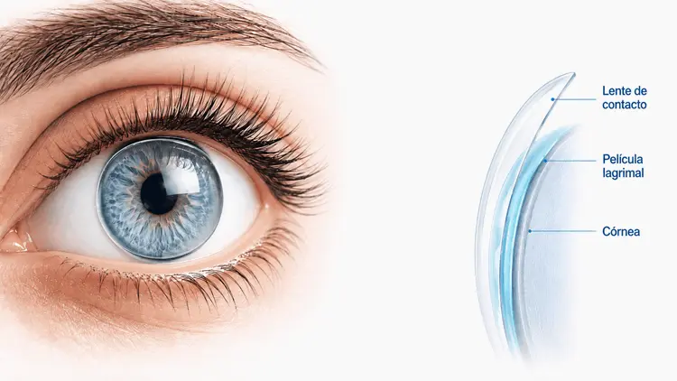 lente_de_contacto_sobre_cornea_ocumed_queretaro_ilustracion_550x310 Ilustración de un lente de contacto colocado sobre la córnea que muestra su adaptación a la superficie del ojo en Ocumed Centro Oftalmológico Querétaro.