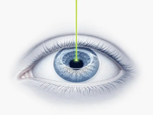 miopia_cirugia_laser_correccion_visual_ocumed_queretaro_600x450 Ilustración de un ojo con un haz láser dirigido hacia la córnea, representativa de cirugía láser para la corrección de la Miopía.