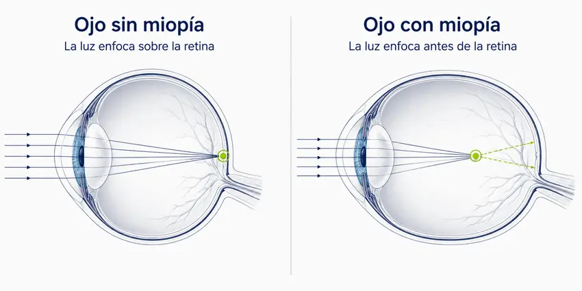 miopia_enfoque_antes_retina_ocumed_queretaro_650x325 Comparación de cómo se ve una avenida de noche con y sin miopía, con las luces convertidas en halos
