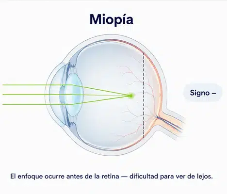 miopia_enfoque_antes_retina_signo_negativo_ocumed_queretaro_468x400 Infografía sobre Miopía que muestra cómo los rayos de luz enfocan antes de la retina, el signo negativo de la graduación y la dificultad para ver de lejos.