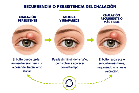 tratamiento_chalazion_recurrencia_persistencia_ocumed_queretaro_550x367 Infografía sobre chalazión recurrente o persistente que muestra su permanencia, mejoría temporal y posible reaparición en el párpado.
