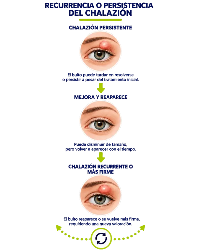 tratamiento_chalazion_recurrencia_persistencia_ocumed_queretaro_680x850 Infografía sobre chalazión recurrente o persistente que muestra su permanencia, mejoría temporal y posible reaparición en el párpado.