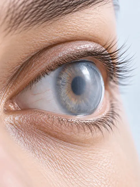 cornea_opacidad_ojo_azul_grisaceo_ocumed_queretaro_488x650 Primer plano de ojo azul grisáceo con apariencia blanquecina sobre la zona corneal, reflejos luminosos y pestañas definidas.