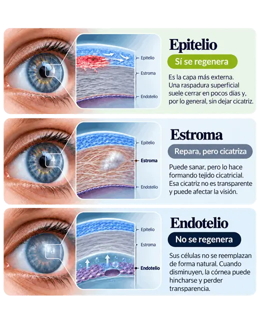 cornea_regeneracion_epitelio_cicatrices_estroma_endotelio_ocumed_queretaro_520x650 Infografía sobre la regeneración de la córnea que compara la reparación del epitelio, la cicatrización del estroma y la limitada regeneración del endotelio.