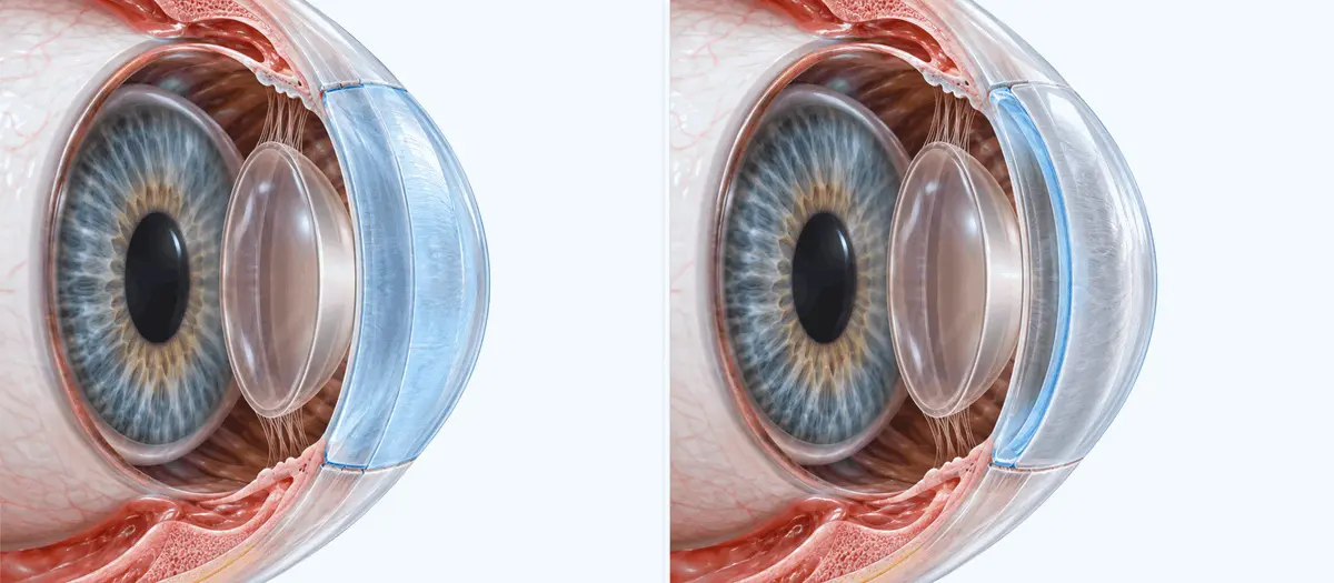 cornea_trasplante_comparacion_anatomia_ocular_ocumed_queretaro_650x284 Ilustración comparativa de dos cortes anatómicos del ojo que muestran diferentes representaciones del tejido corneal relacionadas con el trasplante de córnea.
