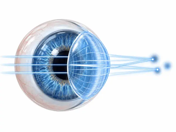 Ilustración de ojo humano azul con rayos de luz refractados que convergen en diferentes puntos, representando el astigmatismo y los errores refractivos.
