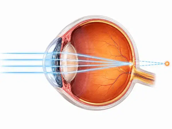Ilustración anatómica de un ojo con hipermetropía donde los rayos de luz se enfocan detrás de la retina, mostrando la córnea y el cristalino.