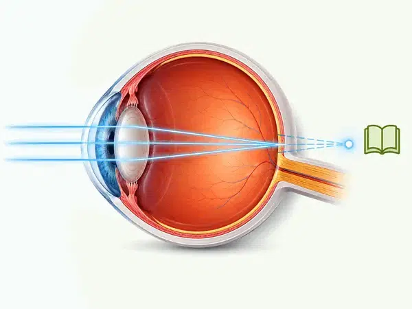 Ilustración anatómica de hipermetropía con rayos de luz que se enfocarían detrás de la retina, junto a un símbolo de lectura cercana.