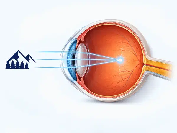 Ilustración anatómica de un ojo con miopía donde los rayos de luz convergen delante de la retina, para comparar su enfoque con la hipermetropía.